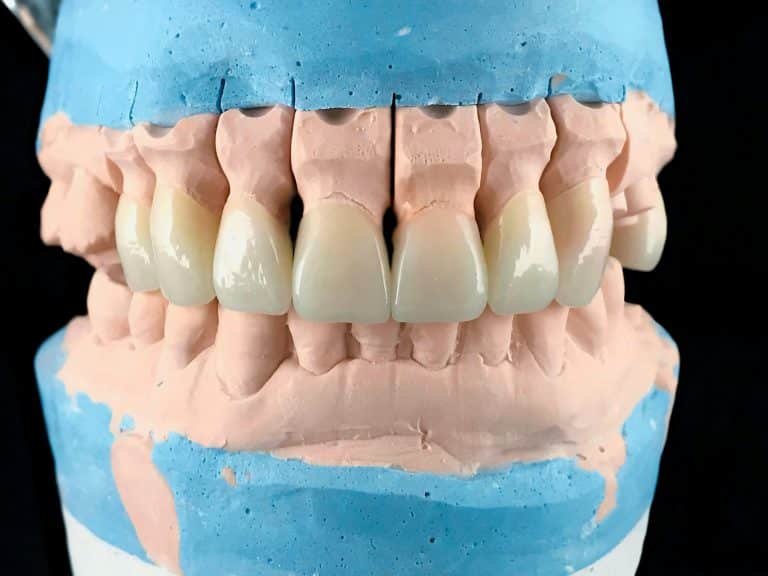 Quelles sont les options de restauration dentaire au Centre dentaire Caroline Prud’homme ?